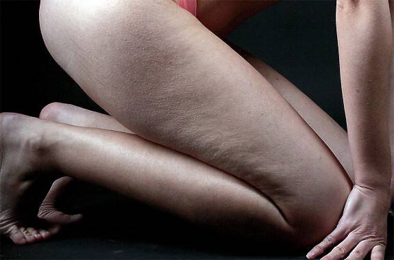 Celulitis | Foto: Lanzi